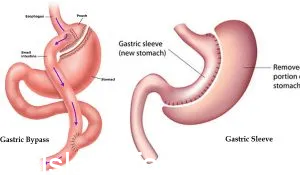 Photo of ما هي عملية تحويل المسار المعدة وأضرارها